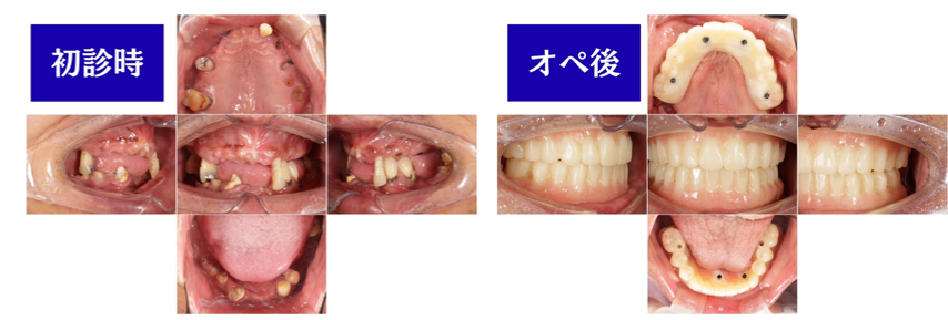 初診時とオペ後の口腔画像