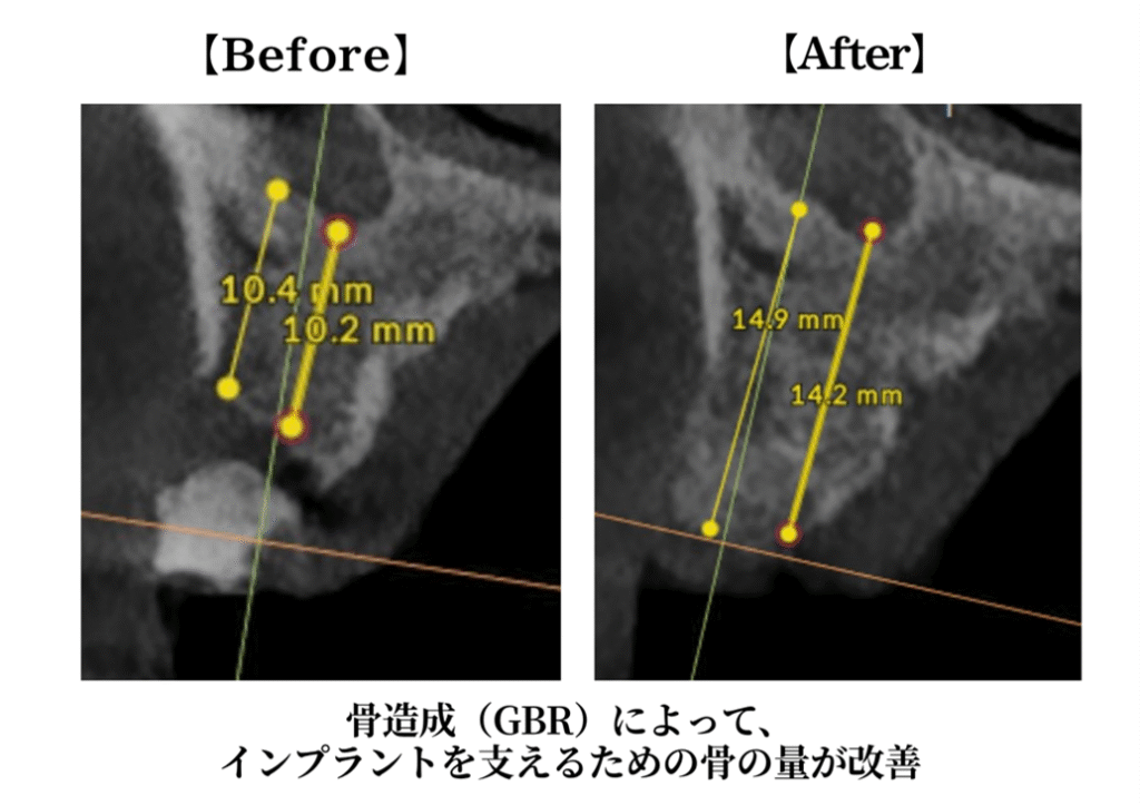 骨造成法BeforeAfter
