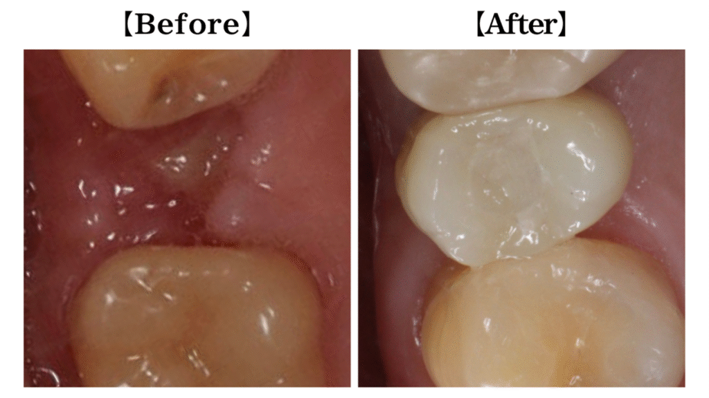 インプラントBeforeAfter
