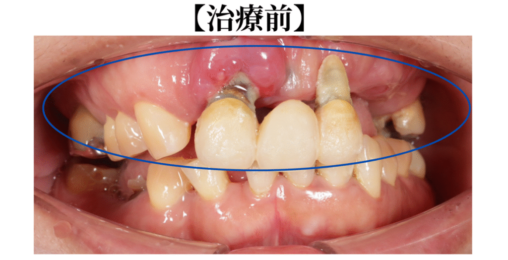 インプラント治療前の画像
