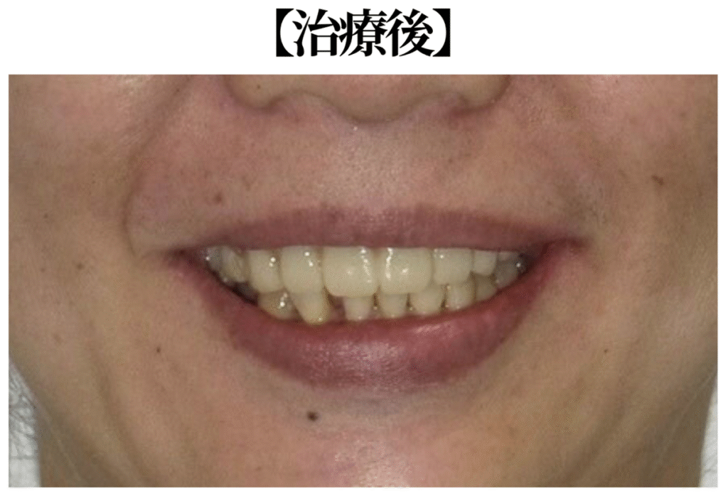 オールオン4治療後の口元画像