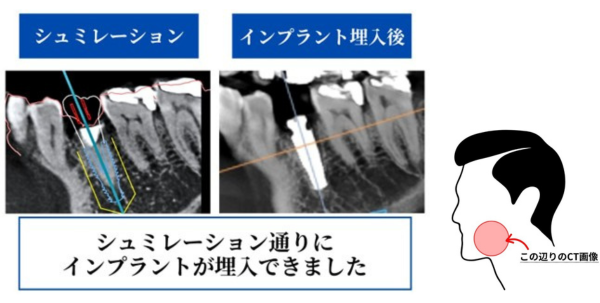 シミュレーションと埋入後のレントゲン