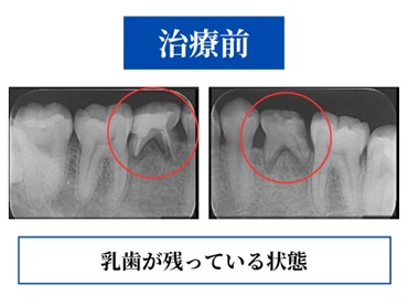 治療前のレントゲン