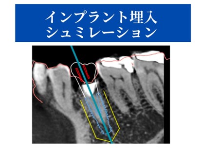 インプラント埋入シミュレーション