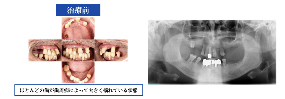 治療前の症例画像とレントゲン