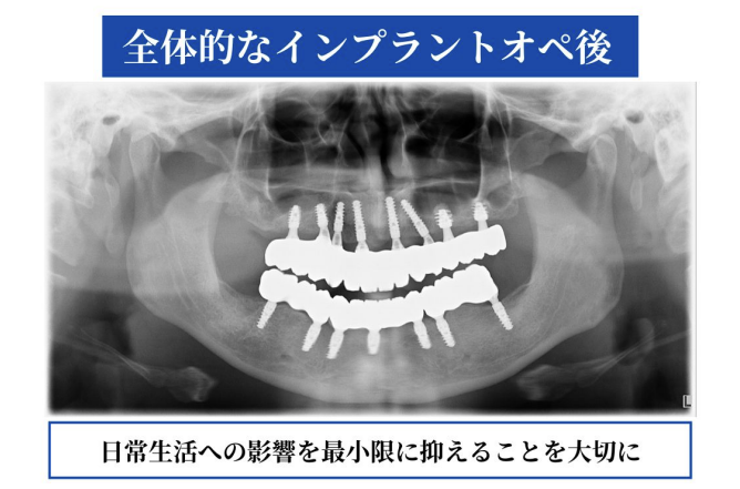 全体的なインプラントオペ後