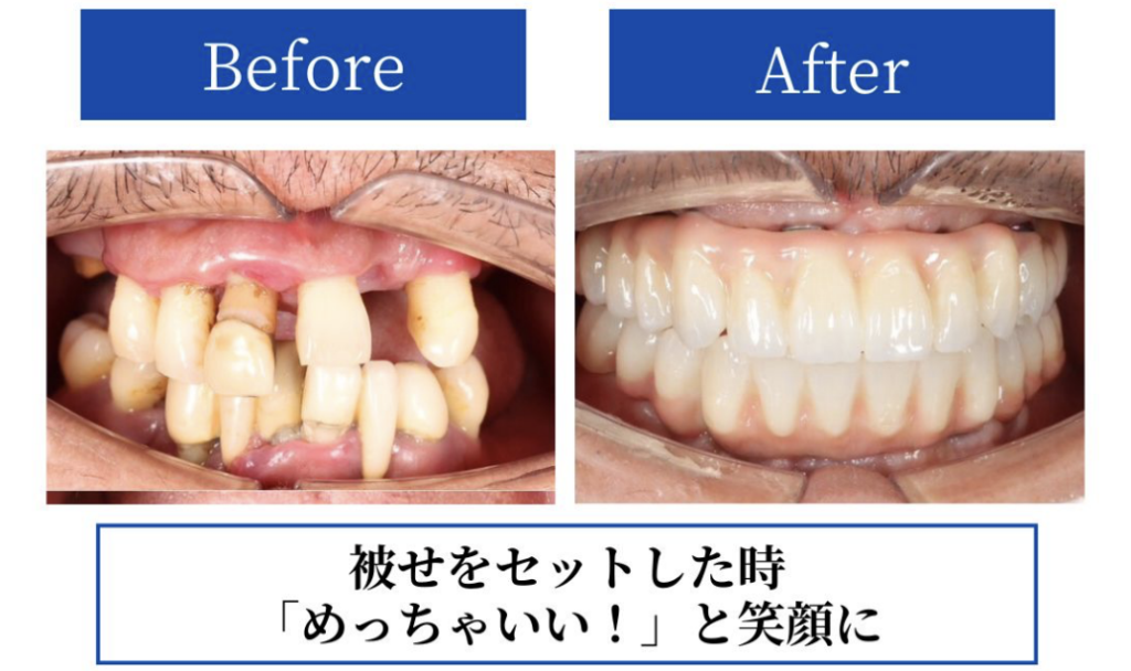 インプラント症例BeforeAfter