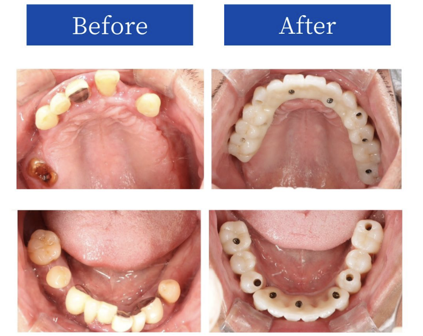 インプラント症例BeforeAfter