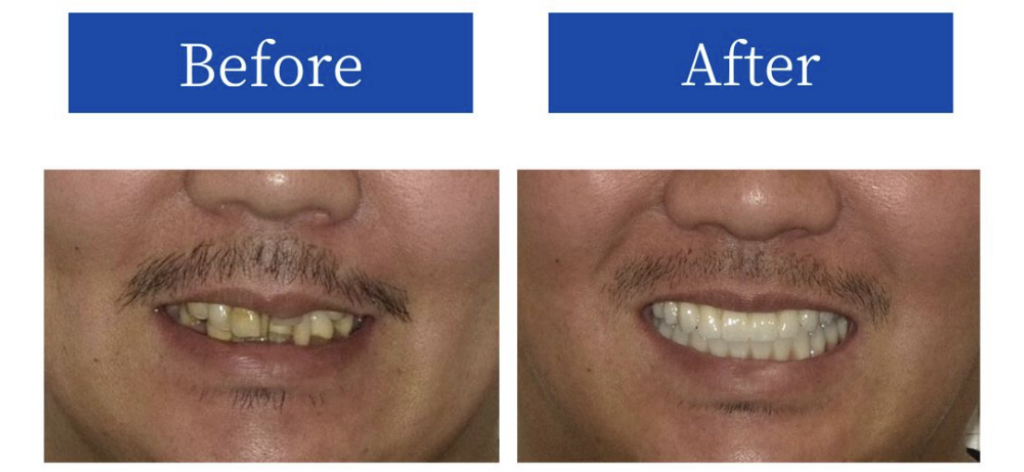 インプラント症例BeforeAfter口元