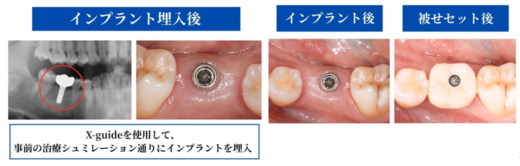インプラント後と被せセット後