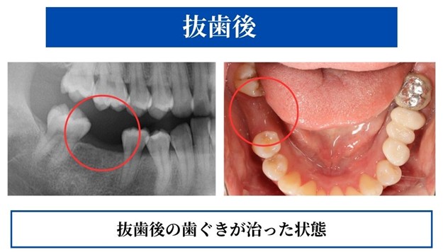 抜歯後の歯茎の回復