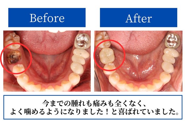 インプラント治療後のBeforeAfter症例画像
