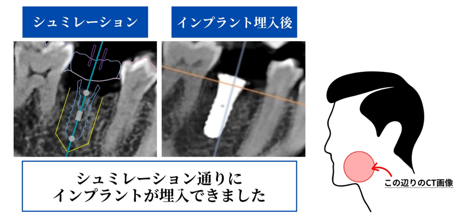 シミュレーションと埋入後のレントゲン