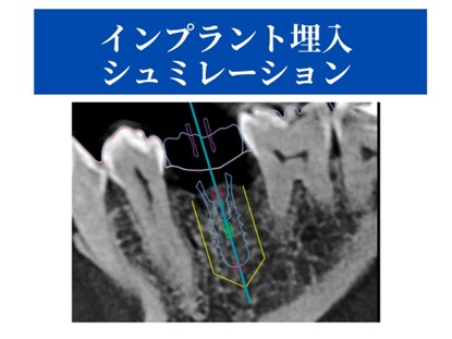 インプラント埋入シミュレーション