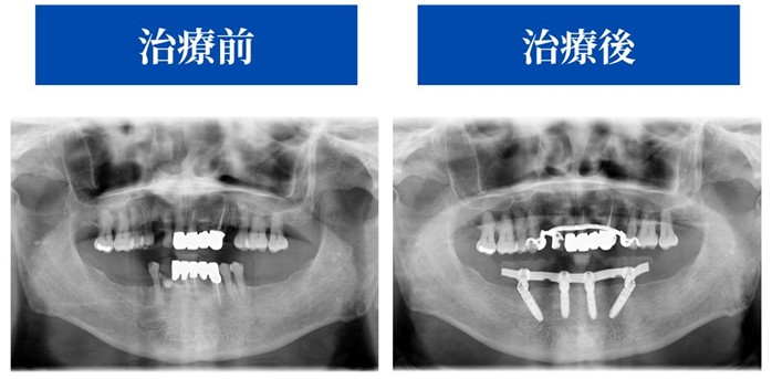 治療前後の症例レントゲン画像