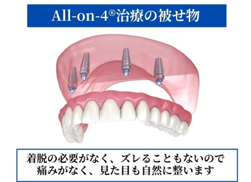 オールオン４治療の被せ物