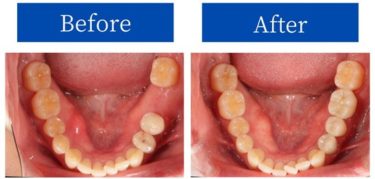 インプラント治療症例画像