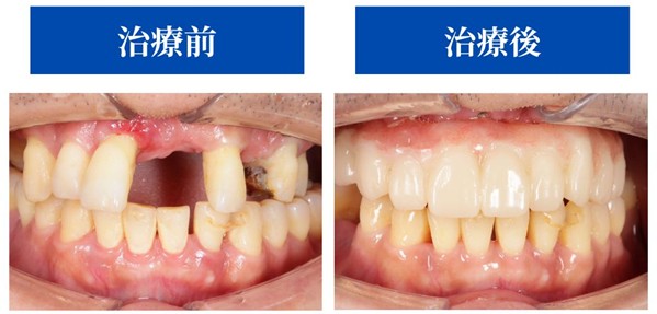 オールオン４治療前後の症例画像