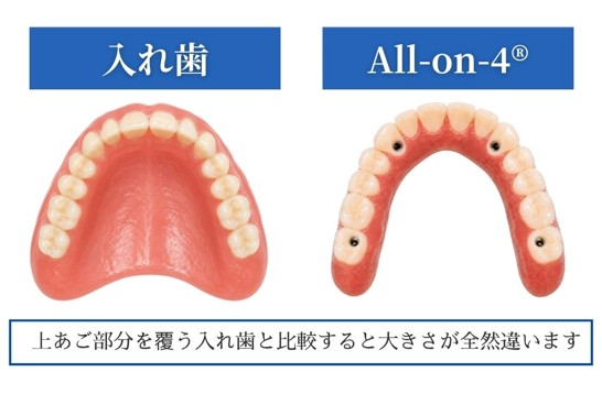 All-on-4と入れ歯の比較画像