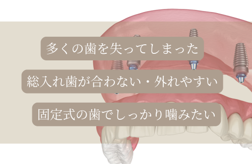 インプラント関連ページへのバナー