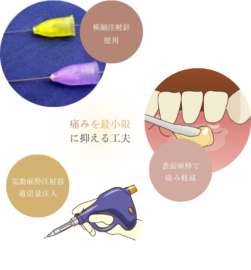 痛みを最小限に抑える工夫