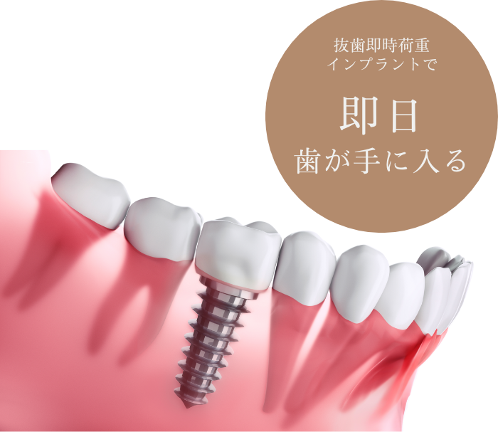 抜歯即時荷重インプラント