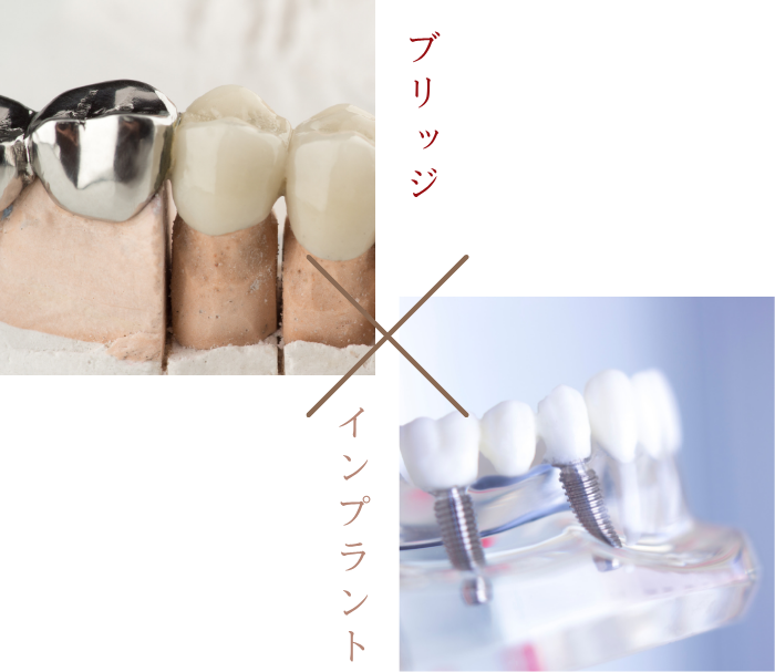 ブリッジとインプラントの審美性の違い