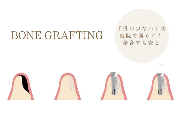 骨造成