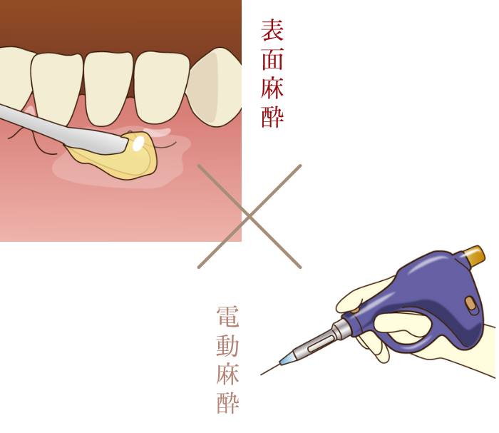 2STEP麻酔法