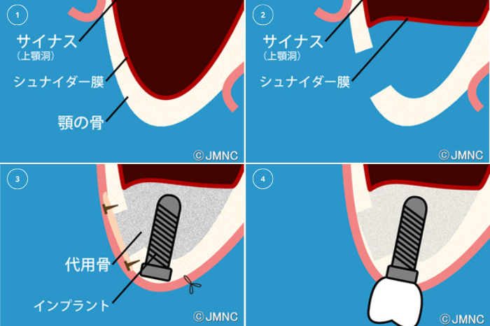 サイナスリフト