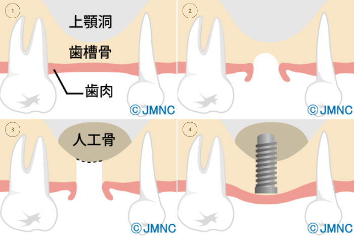 ソケットリフト
