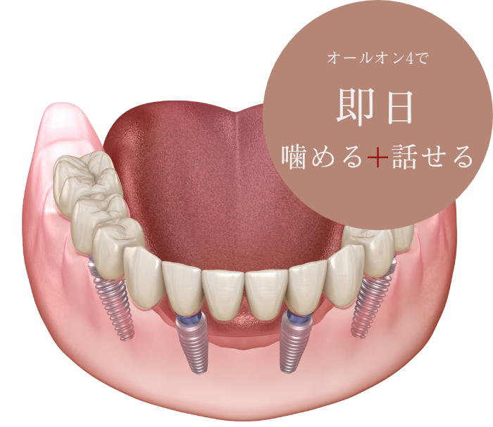 オールオン4