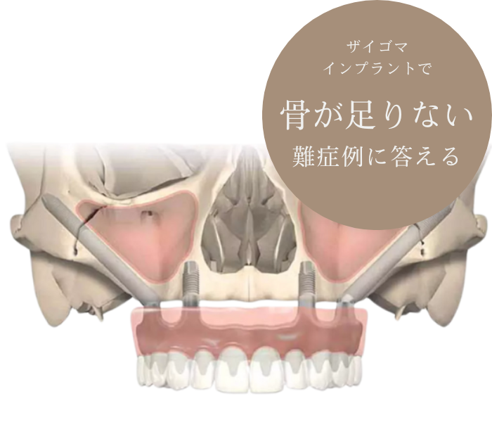ザイゴマ