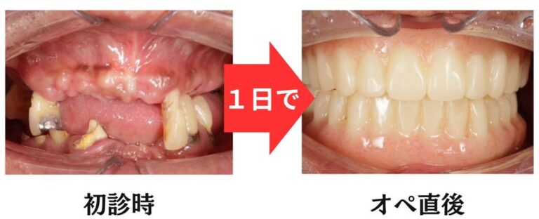 【症例紹介】岡山でオールオン4ザイゴマインプラント治療｜入れ歯が合わない方へ新しい選択肢
