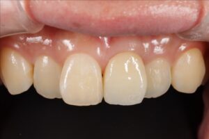 前歯のインプラント術後