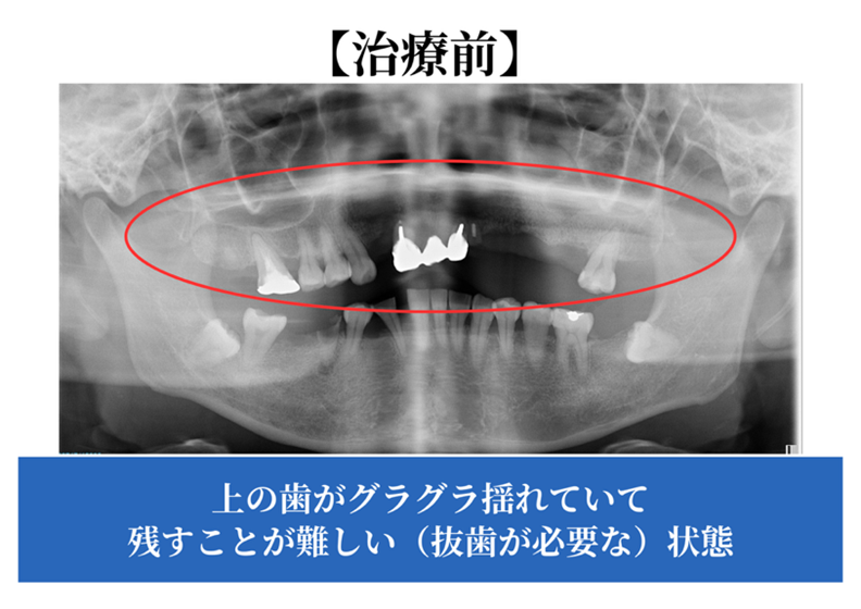 オールオン４治療前のレントゲン