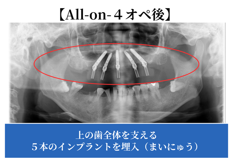 オールオン４治療後のレントゲン