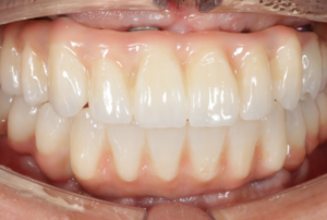 オールオン X：全顎インプラント治療After