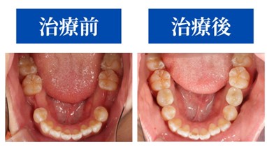 【症例紹介】下顎インプラント治療<br>乳歯が残っていた20代男性