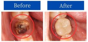 インプラント治療の症例BeforeAfter画像