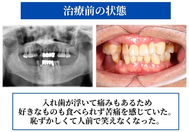 【下顎All-on-4®︎症例】入れ歯の痛みと苦痛から解放<br>「なんでも噛める」「人目を気にせず笑える」<br>口元を取り戻した症例｜73歳男性